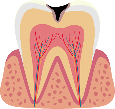 象牙質の虫歯(C2)