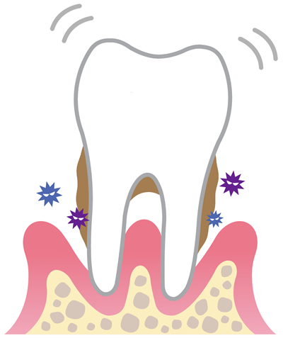 重度の歯周病